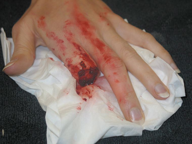 raelene-cut-off-finger-assessment-by-michelle.jpg