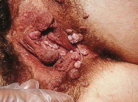 warts-wikipedia2.jpg